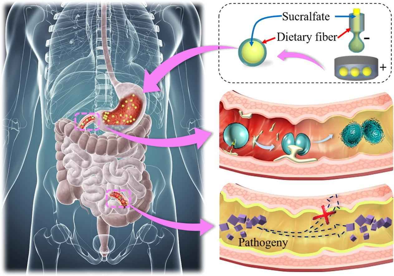 Sucralfate as a Key Component in Biomimetic Intestinal Barriers for Preventing Intestine-Derived Diseases